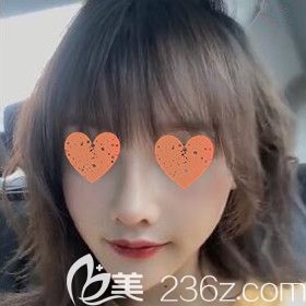 在長沙地區(qū)做完鼻綜合術(shù)后半個月效果照 在長沙地區(qū)做完鼻綜合術(shù)后半個月效果照