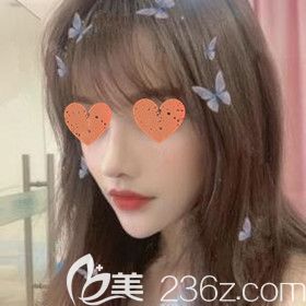 在長沙希美醫(yī)療美容做了肋軟骨鼻綜合后我終于擁有迷人小翹鼻了！