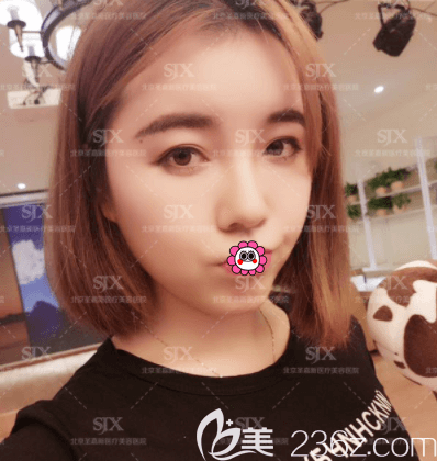 在北京圣嘉新做SVF三聯(lián)脂肪活顏術(shù)第7天樣子