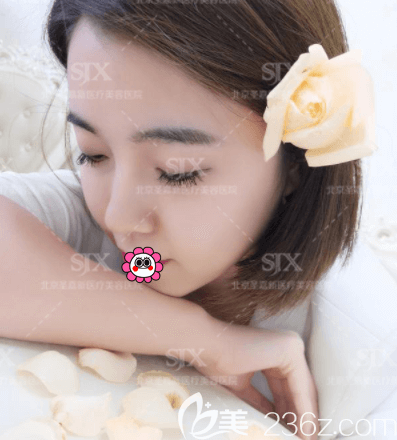 北京圣嘉新SVF三聯(lián)脂肪活顏術(shù)案例