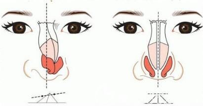 硅膠假體隆鼻可以放一輩子嗎？