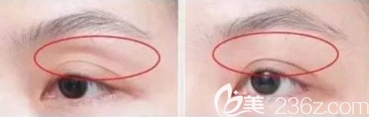 自體脂肪填充眼窩案例 自體脂肪填充眼窩案例