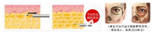 填充眼窩用自體脂肪的優(yōu)點 填充眼窩用自體脂肪的優(yōu)點