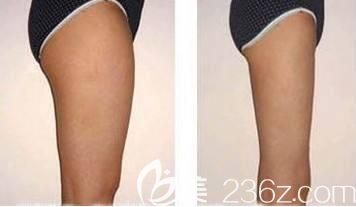 吸脂瘦大腿術(shù)前術(shù)后對比照