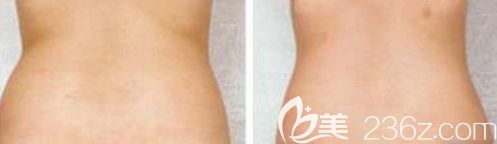 做冷凍溶脂術(shù)前術(shù)后對比效果