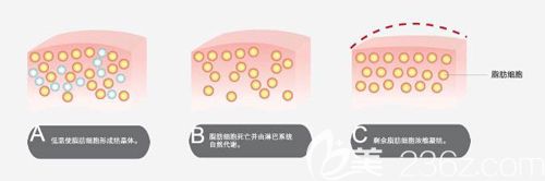 做冷凍溶脂的手術(shù)步驟簡易效果圖