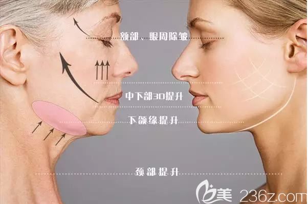 面部線雕提升原理介紹