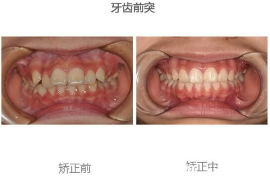 尚愛(ài)韓美口腔申晶小姑娘牙齒前突矯正案例