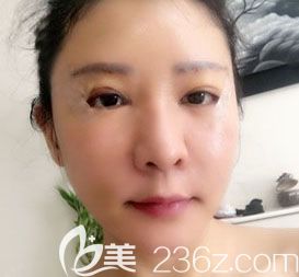 韓國(guó)眼部修復(fù)醫(yī)生哪個(gè)好？韓國(guó)BIO辛容鎬案例