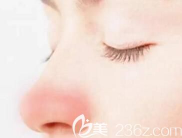 隆鼻后鼻子一直發(fā)紅怎么回事？