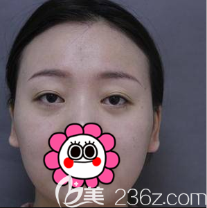 我找北京圣嘉新黃海濱做雙眼皮前樣子 我找北京圣嘉新黃海濱做雙眼皮前樣子