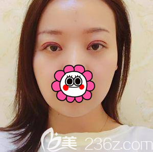 黃海濱給我做眼綜合術(shù)后當(dāng)天照 黃海濱給我做眼綜合術(shù)后當(dāng)天照