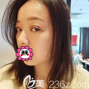 我在北京圣嘉新做眼綜合第4天樣子 我在北京圣嘉新做眼綜合第4天樣子