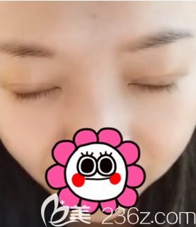 北京圣嘉新眼綜合案例 北京圣嘉新眼綜合案例