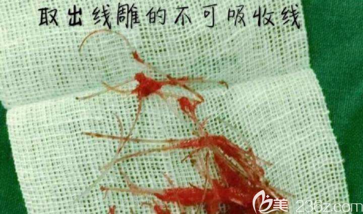 線雕隆鼻取出的不可吸收線