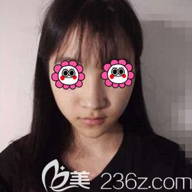 在長沙做鼻綜合術(shù)前照 在長沙做鼻綜合術(shù)前照