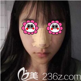 在長沙梵童做鼻綜合術(shù)后1天照 在長沙梵童做鼻綜合術(shù)后1天照