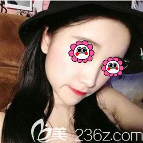 塌鼻子的我在長(zhǎng)沙梵童醫(yī)療美容做完鼻綜合后終于擁有立體小翹鼻！