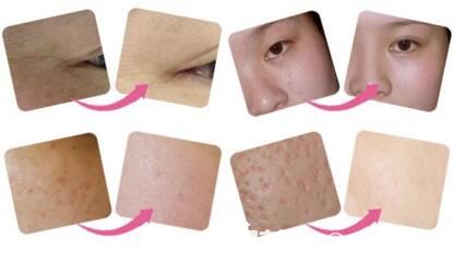 光子嫩膚前后對比效果照