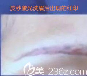 洗眉后出現(xiàn)的紅印現(xiàn)象