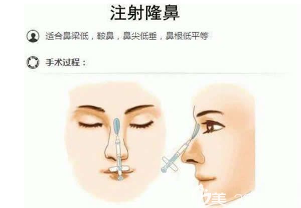 注射玻尿酸隆鼻示意圖