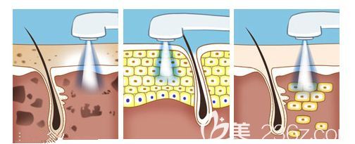 光子嫩膚去痘印原理