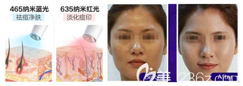 光子嫩膚去痘印效果明顯