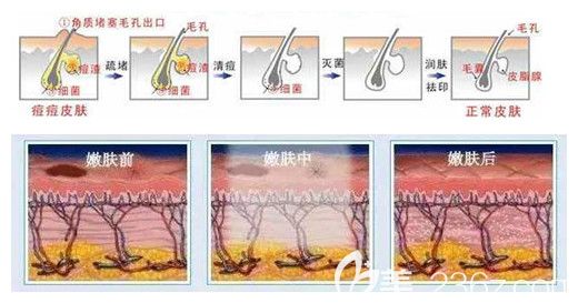 做光子嫩膚去痘印的優(yōu)勢