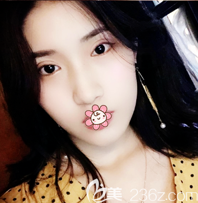 之所以來珠海新顏找蘇錦和做雙眼皮是因?yàn)樯磉吅脦讉€(gè)朋友都是找他做的眼睛效果很自然