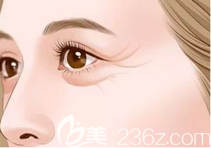 有眼袋的眼部示意圖