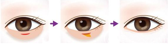 內(nèi)切祛眼袋手術(shù)圖