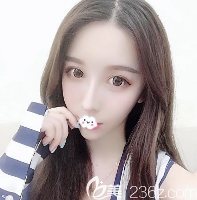 看完珠海正規(guī)隆鼻整形醫(yī)院排名后找珠海新顏蘇錦和院長做了隆鼻失敗修復(fù)手術(shù)