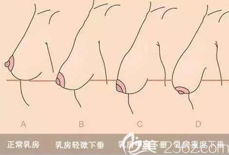 乳房下垂稱度自測