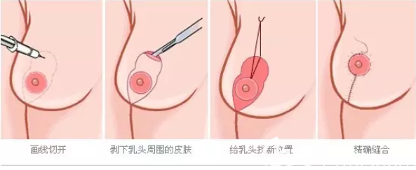 乳暈周邊上提固定