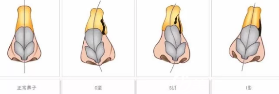 歪鼻矯正 歪鼻矯正