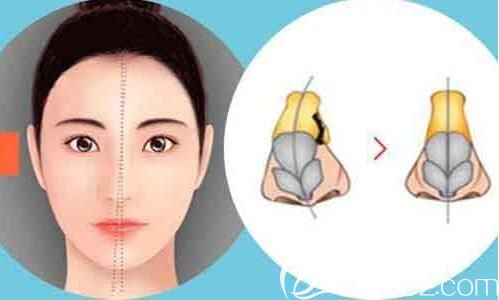 鼻小柱延長用那個材料好？