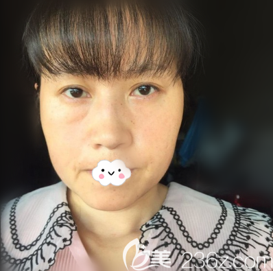 成美激光祛斑術(shù)后20天