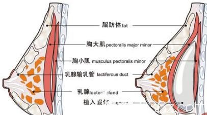 假體隆胸假體放置在胸大肌下