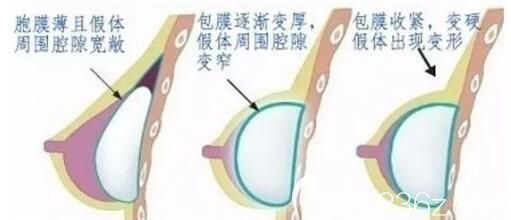 假體隆胸失敗會出現(xiàn)包膜攣縮