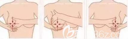 預(yù)防包膜攣縮按摩手術(shù)法圖