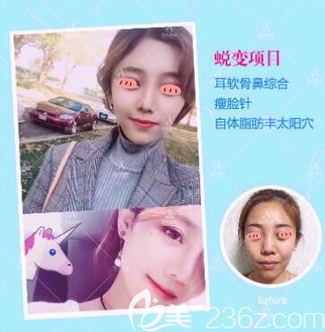 洛陽愛尚耳軟骨隆鼻案例 洛陽愛尚耳軟骨隆鼻案例