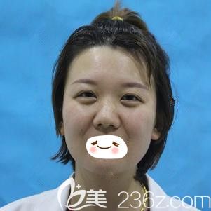 在<!--<i data=20240703-sp></i>-->注射玻尿酸祛除法令紋術(shù)前顯老 在<!--<i data=20240703-sp></i>-->注射玻尿酸祛除法令紋術(shù)前顯老