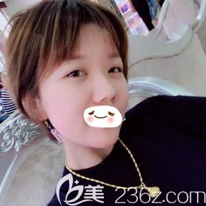 陳雨雁醫(yī)生為我注射玻尿酸祛除法令紋術(shù)后3天消腫 陳雨雁醫(yī)生為我注射玻尿酸祛除法令紋術(shù)后3天消腫