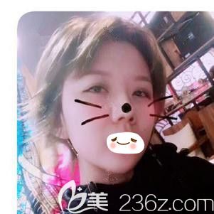 不知道祛除法令紋哪種方法好?來看我用海薇玻尿酸填充后效果是否真實自然