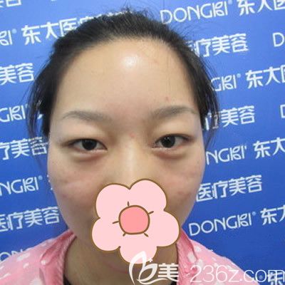 我找泉州東大吳新建醫(yī)生割雙眼皮術(shù)前照 我找泉州東大吳新建醫(yī)生割雙眼皮術(shù)前照