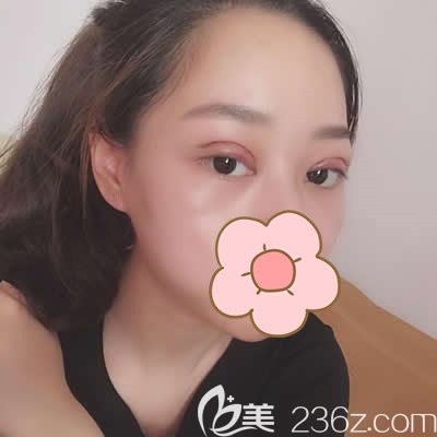 看看泉州東大吳新建為我做雙眼皮術(shù)后2天照片 看看泉州東大吳新建為我做雙眼皮術(shù)后2天照片