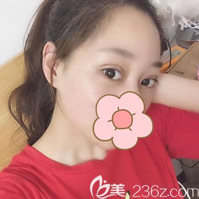 我找泉州東大吳新建醫(yī)生做雙眼皮術(shù)后7天效果 我找泉州東大吳新建醫(yī)生做雙眼皮術(shù)后7天效果