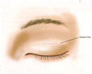微創(chuàng)雙眼皮