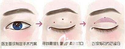 微創(chuàng)雙眼皮是韓式定點(diǎn)雙眼皮嗎？