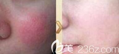 做祛紅血絲術(shù)前術(shù)后對比照